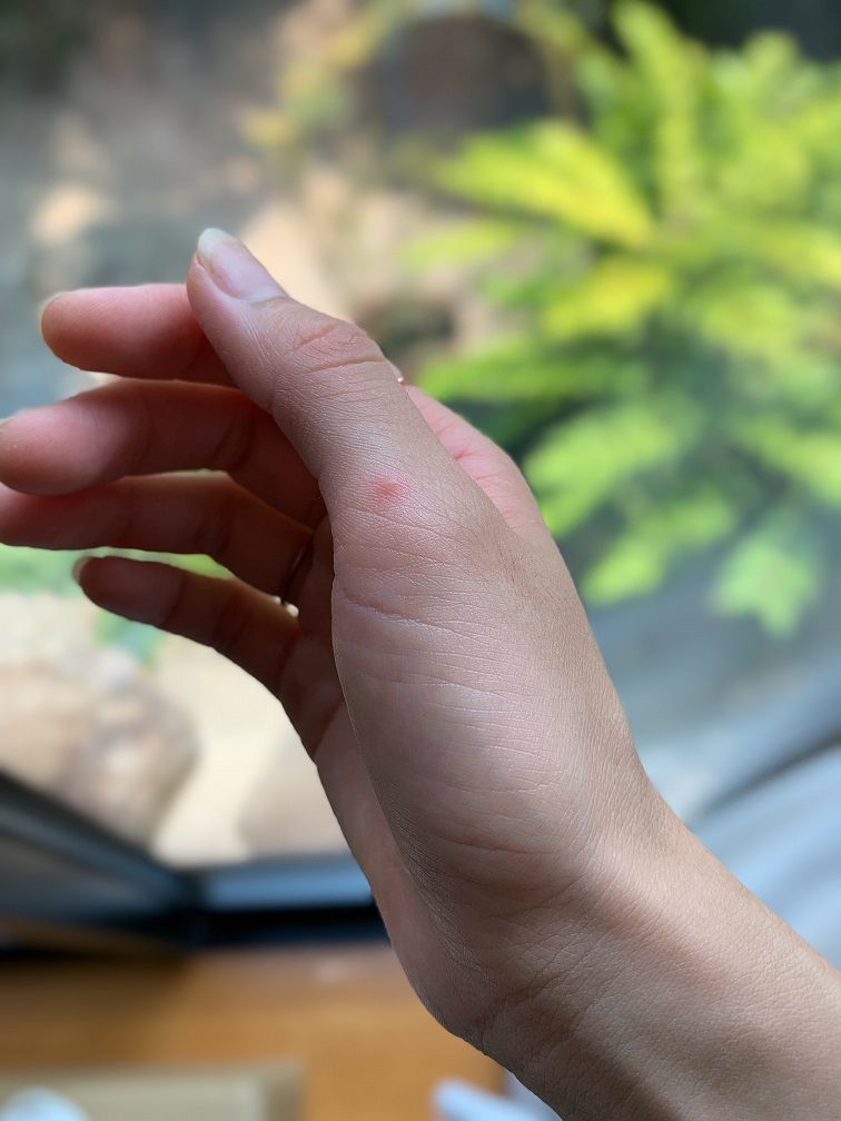 大人の手足口病は重症化するって本当！？軽い症状で済むこともあるの？